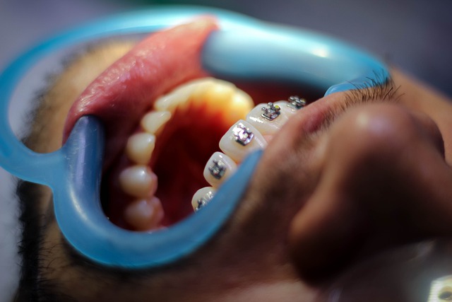 טיפול של יישור שיניים